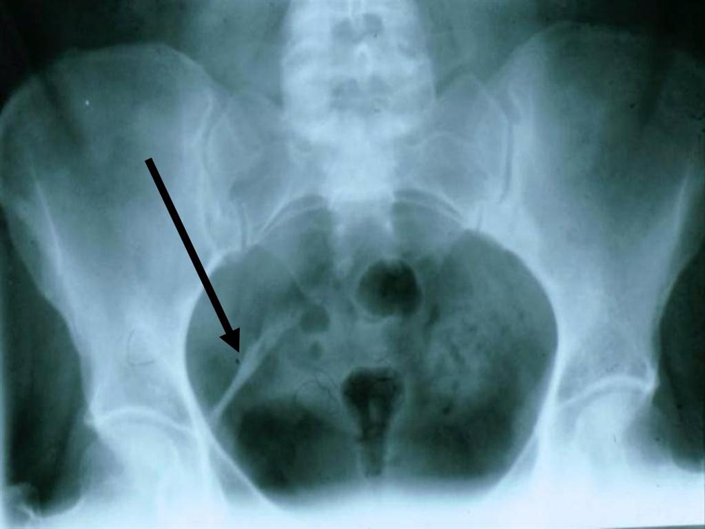 sacral DISH